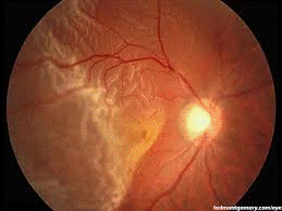 retina dekolmanı.png