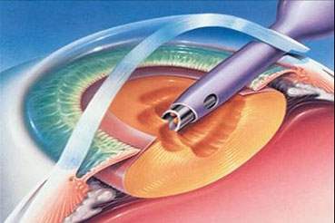 Fako Katarakt Ameliyatlarında Merceğin önemi nedir?