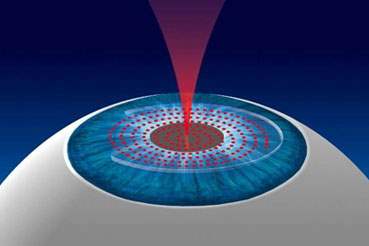 Femtosecond Lazer