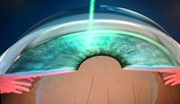 Göz lazer tedavisi ne kadar sürüyor?