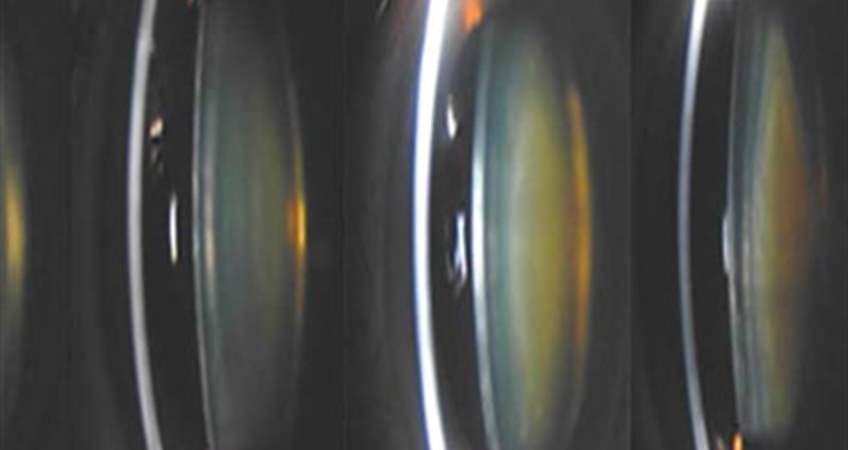 Katarakt ameliyatı sonrasında lens gözde ne kadar kalır?