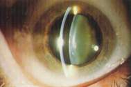 Katarakt Hakkında Bilinen Yanlışlar: Katarakt Gözün Yüzeyini Bulandırır
