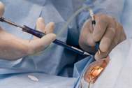 Kataraktı almak için kullanılan cerrahi yöntemler nelerdir?