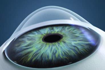 Keratoconus