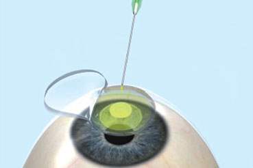 Korneal Crosslinking