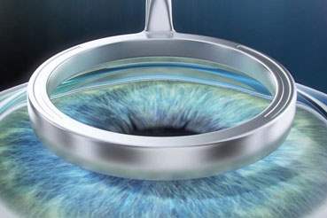 LASEK ve NO-TOUCH Tedavisinin Lasik Yönteminden Farkı