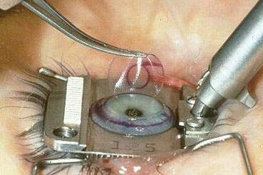 Lasik-PRK (Laser Cerrahisi) Lasik Ameliyatı Sonrası Komplikasyonlar