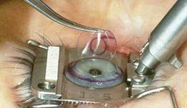 Lasik-PRK (Laser Cerrahisi) Lasik Ameliyatı Sonrası Komplikasyonlar
