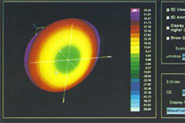 Topolazer Lasik