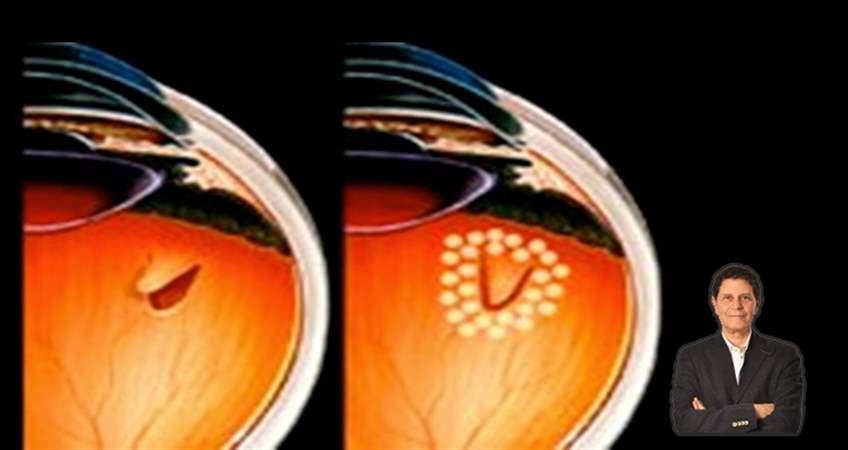 Retina Dekolmanı - Yırtılması Nedir?